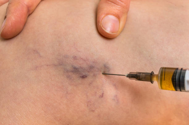 istock Spider veins on female leg - varicose veins concept 1010055868