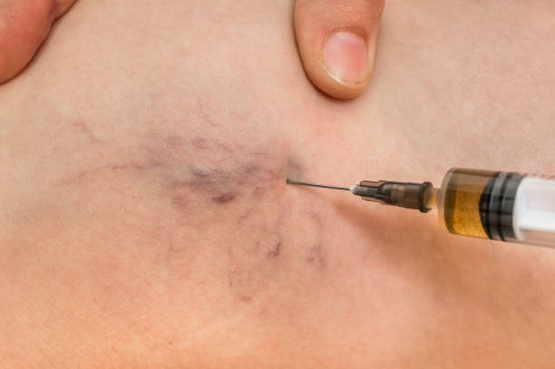 istock Spider veins on female leg - varicose veins concept 1010058544