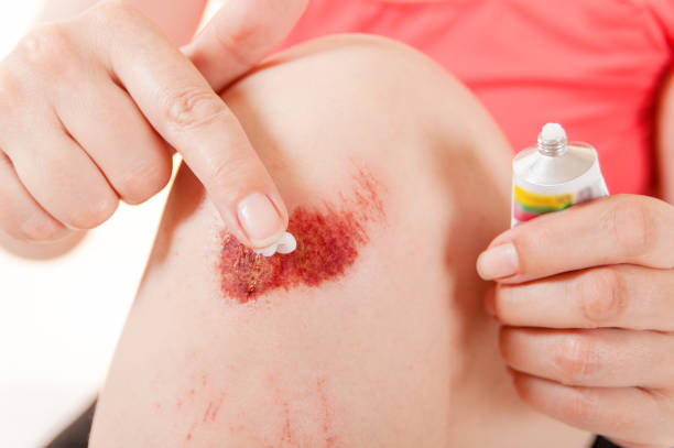 istock woman smears ointment on a broken knee, close-up 1010074714