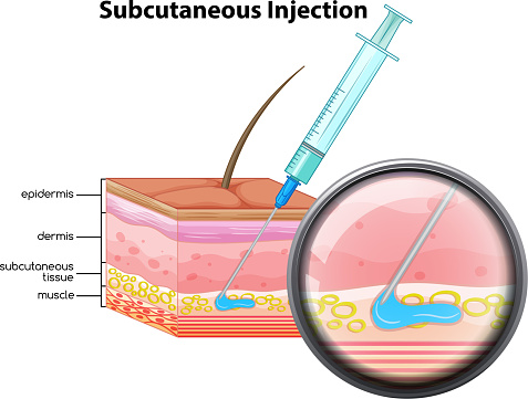 Skin subcutaneous Injection diagram illustration