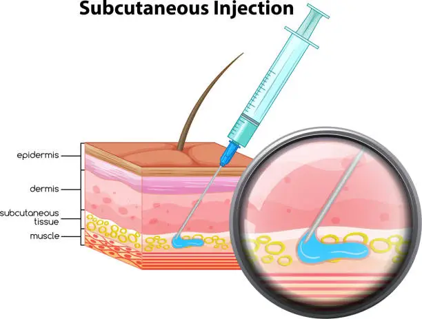 Vector illustration of Skin subcutaneous Injection diagram