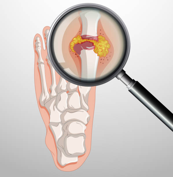 человеческие ноги с подагрой - gout stock illustrations