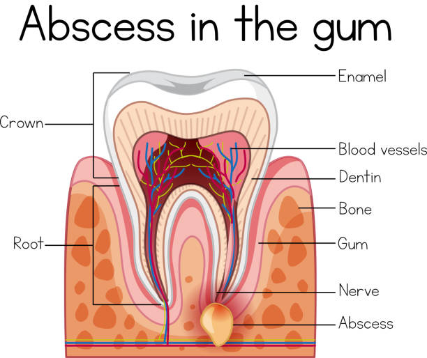 Dental Abscess Stock Photos, Pictures & Royalty-Free Images - iStock