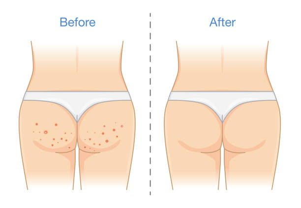 Buttocks with many pimples and after skin treatment. Buttocks with many pimples and after skin treatment. Illustration about health care. acne-cartoon stock illustrations