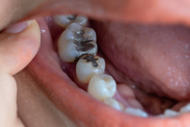 istock Dental fillings and dental caries. 1010678322