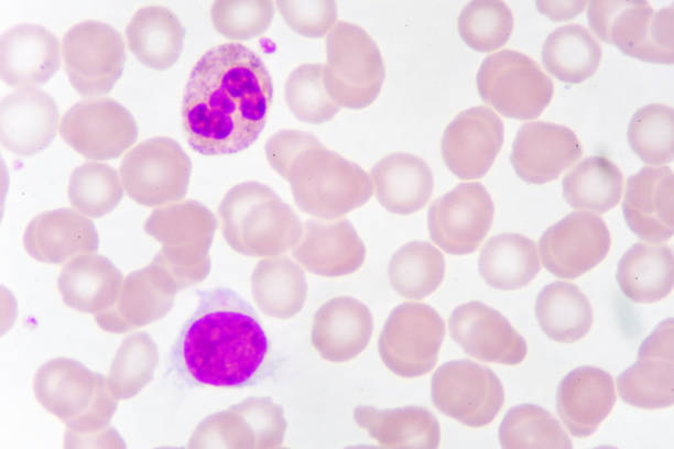 istock White blood cell in blood smear 1010744970