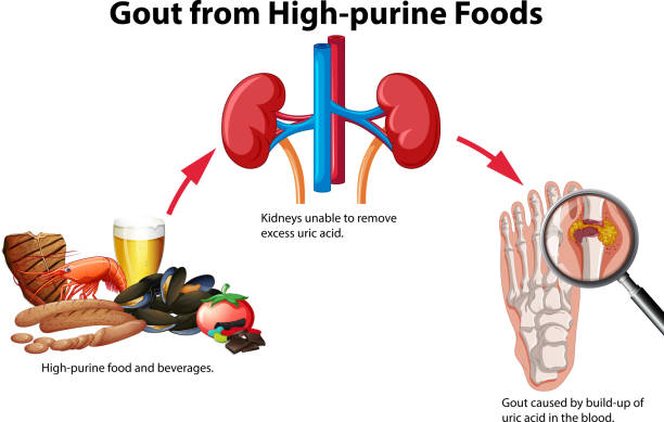 подагра из продуктов с высоким пурином - gout stock illustrations