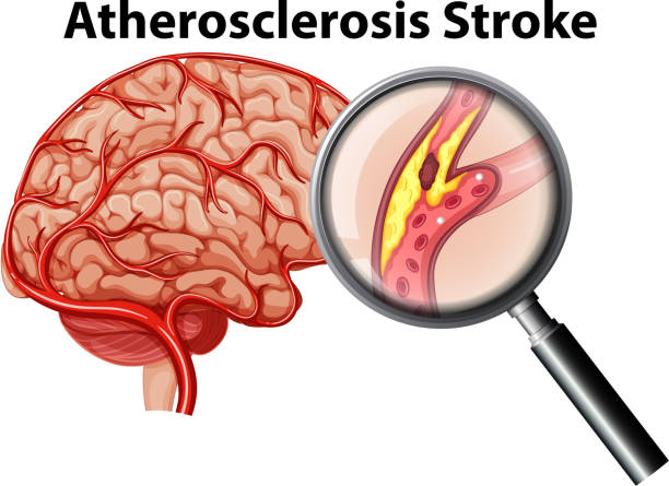Atherosclerosis Stroke on White Background Atherosclerosis Stroke on White Background illustration atherosclerosis stock illustrations