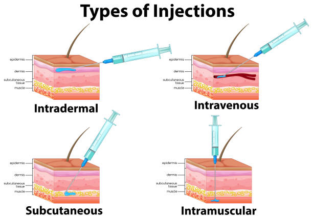 ilustraciones, imágenes clip art, dibujos animados e iconos de stock de un sistema de tipo de inyecciones - dermis