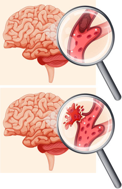 menschliche gehirn und hämorrhagischer schlaganfall - endhirn stock-grafiken, -clipart, -cartoons und -symbole