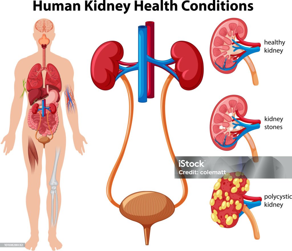 Condiciones de salud de riñón humano - arte vectorial de Cuerpo humano libre de derechos