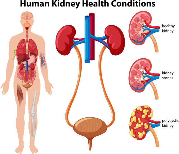 Human Kidney Health Conditions Human Kidney Health Conditions illustration kidney organ stock illustrations