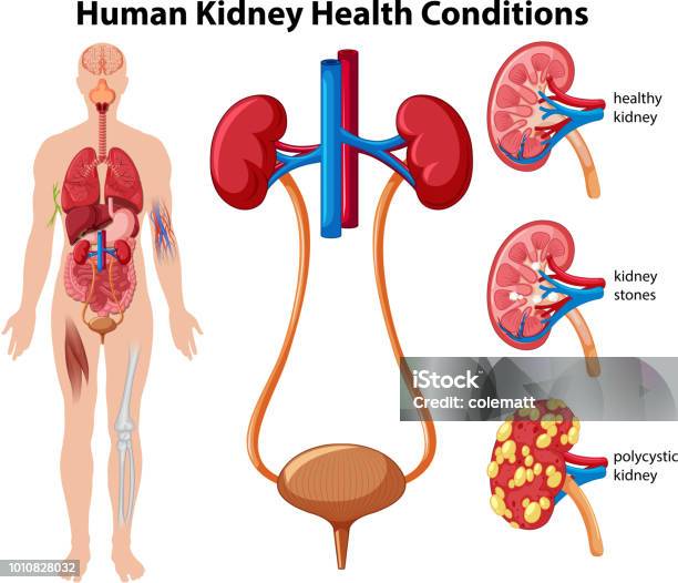 Human Kidney Health Conditions Stock Illustration - Download Image Now - The Human Body, Kidney - Organ, Anatomy