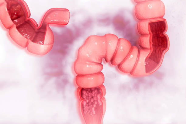 istock Colon cancer. Cancer attacking cell. Colon disease concept 1011131838