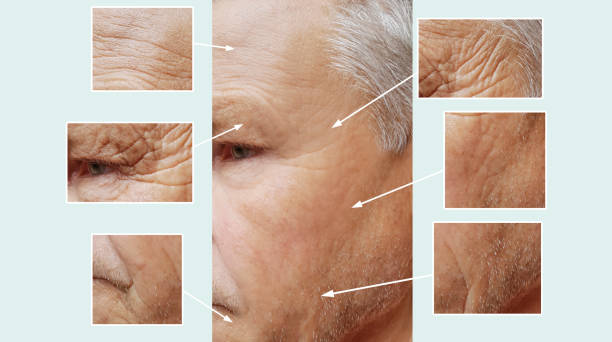istock old man, wrinkles on face before and after procedures 1011250516