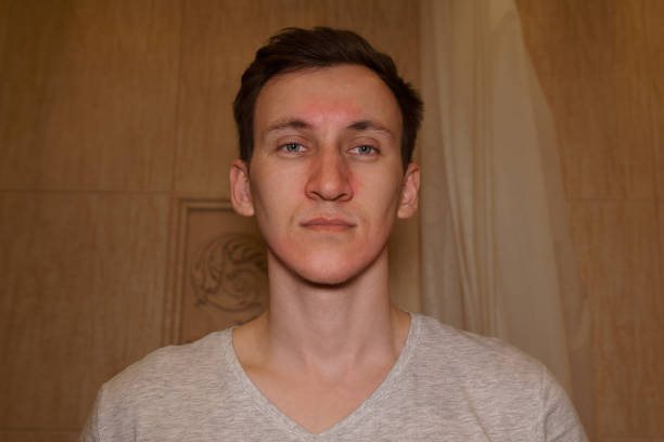 istock Red face after allergic reaction of a young man 1011857178