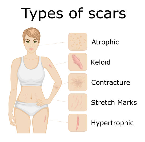 Types of scars Illustration of five types of scars on the body of a young girl atrophy stock illustrations