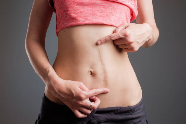 Woman with long abdominal scars after operation European woman with long abdominal scars after operation standing on black color scar stock pictures, royalty-free photos & images