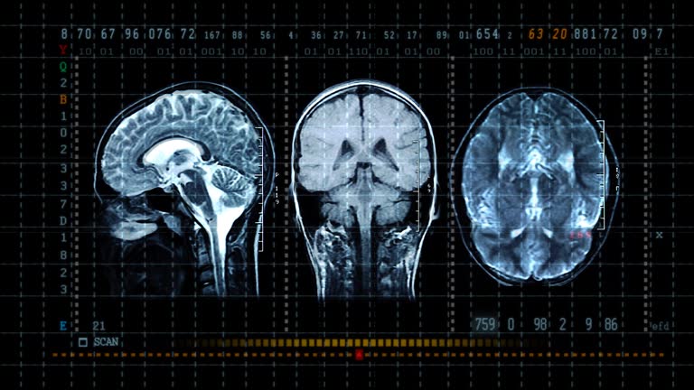 Brain MRT scan display