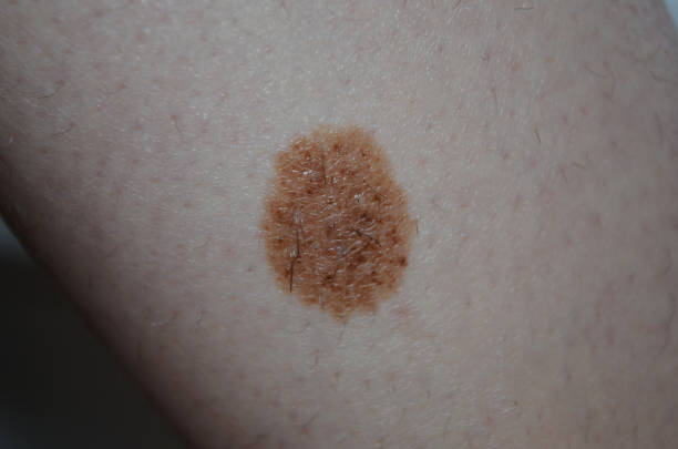 istock round birthmark on light skin 1012573386