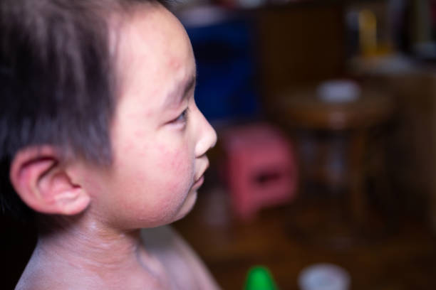 istock asian boy allergy to pine moth worm 1012779264