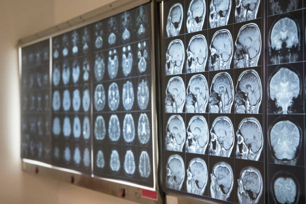 istock Brain MRI on lightbox in medical office 1012838550