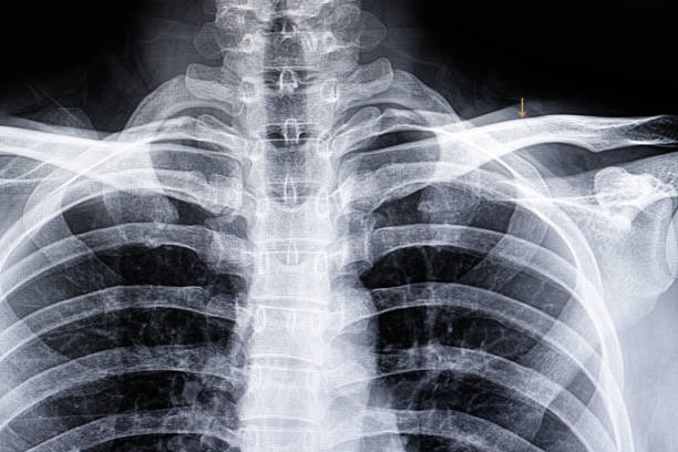 A chest xray film A chest xray film of a patient with car accident showing hairline fracture of left clavicle clavicle stock pictures, royalty-free photos & images