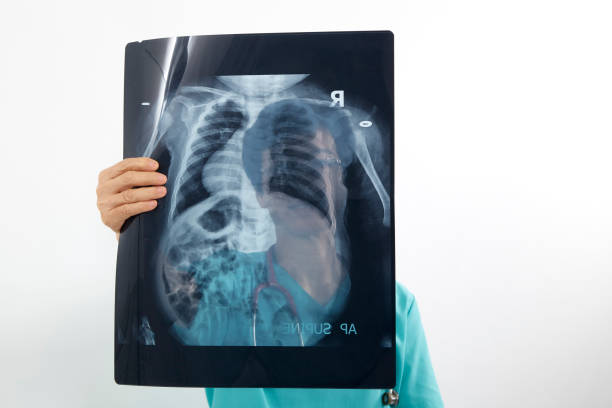 istock Doctors examining x-ray of chest and ribs 1013047196