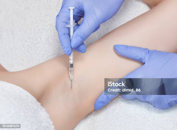 The Doctor Makes Intramuscular Injections Of Botulinum Toxin In The Underarm Area Against Hyperhidrosis Stock Photo - Download Image Now