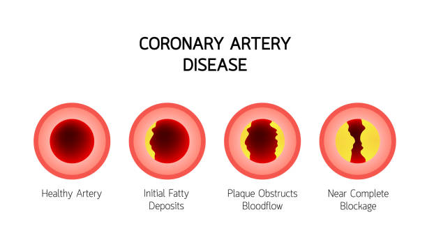 ilustrações, clipart, desenhos animados e ícones de artéria coronária doença - stroke vascular symptoms patient