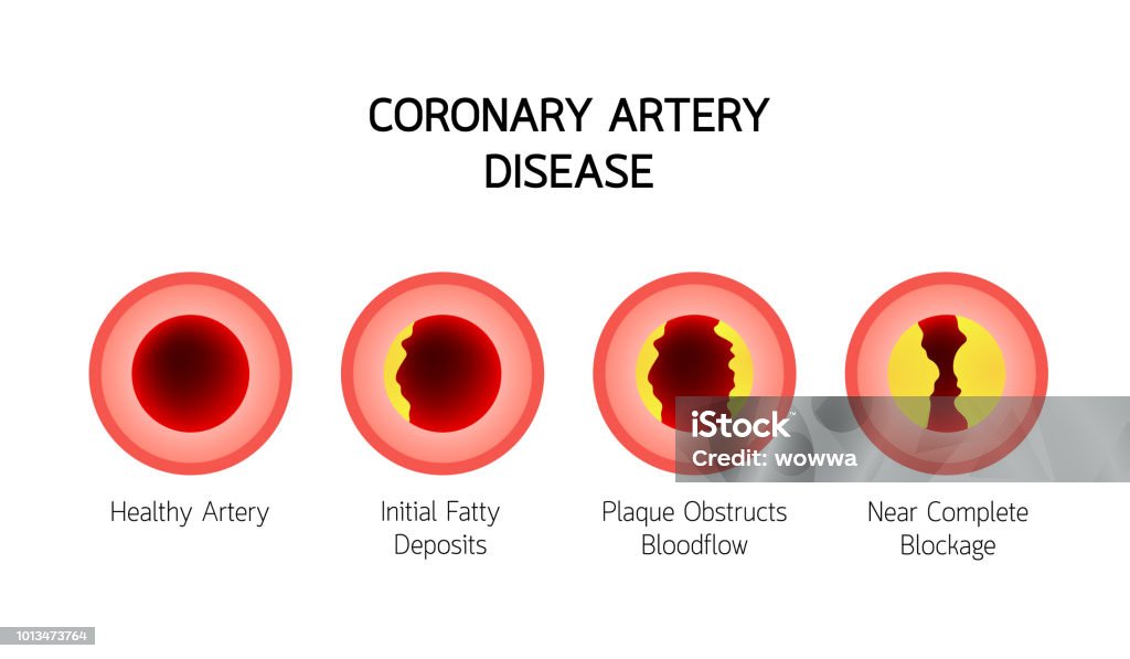 Coronary Artery Disease Stock Illustration - Download Image Now