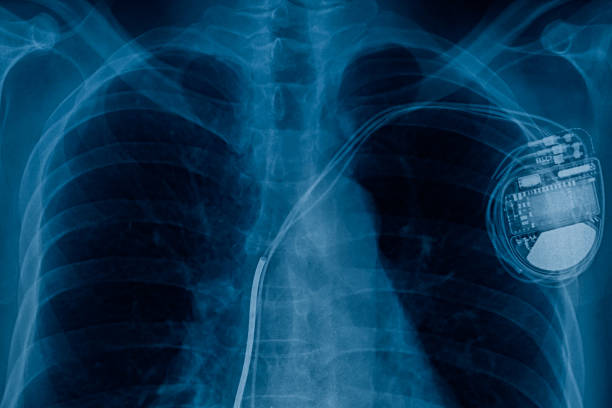 pacemaker cell x-ray image stock photo