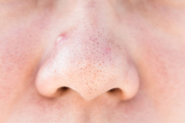 istock close up of black head 1013993602