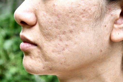 Problema de la piel con acné enfermedades, Close up rostro mujer con espinillas whitehead, menstruación breakout, cicatriz y cara grasienta aceitosa, concepto de belleza. photo