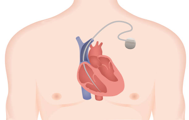Artificial cardiac pacemaker vector illustration. Implantable Cardioverter Defibrillator Implantable Cardioverter Defibrillator vector illustration heart ventricle stock illustrations