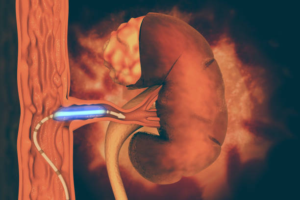 istock Stent angioplasty. Peripheral artery disease 1014774128