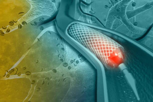 istock Stent angioplasty 1014775166