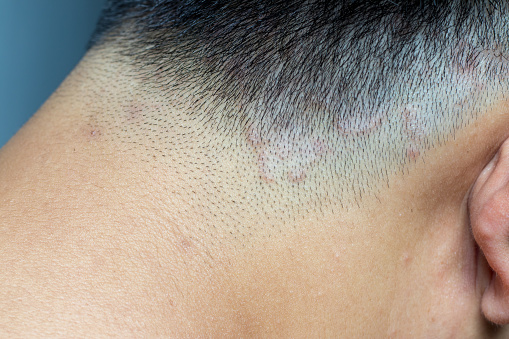 Closed up of ringworm (tinea) on head of asian man (Dermatitis)