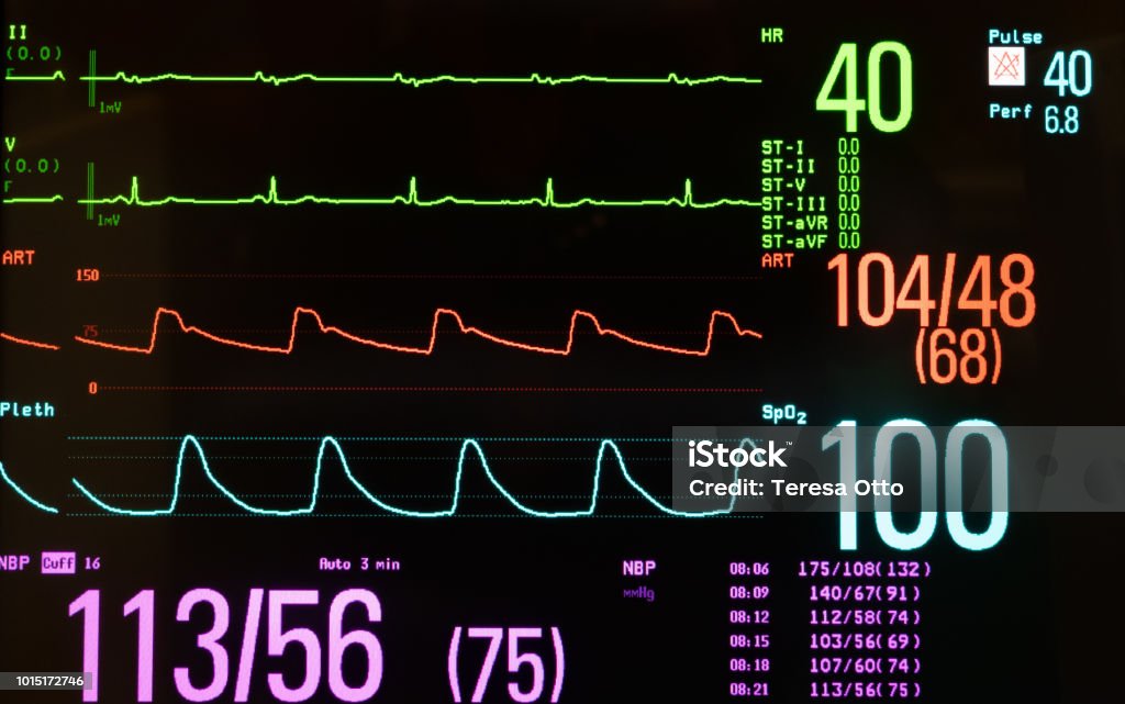 Medical Monitor Showing Bradycardia, Blood Pressure and Oxygen Level Medical monitor with bradycardia, normal blood pressure and oxygen level against a black background. Electrocardiography Stock Photo