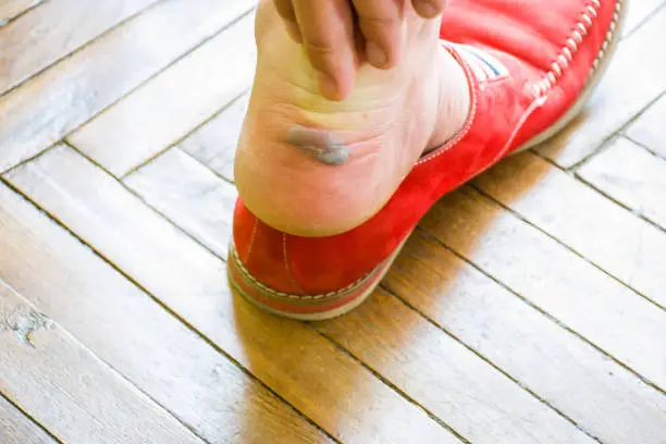 The man reaches out to a large calluses or blister with fluid on foot near the heel after removing the shoes. The emergence of calluses from wearing tight or uncomfortable shoes