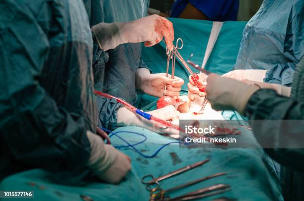 Hysterectomy Surgerygeneral View During Surgery Stock Photo - Download  Image Now - Hysterectomy, Surgery, Abdomen - iStock