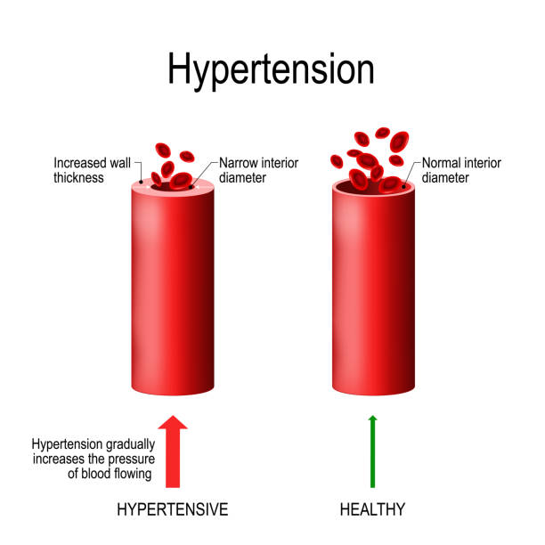 dwa naczynia krwionośne: czerwone krwinki, zdrowe i naczynie z nadciśnieniem tętniczym. - cholesterol atherosclerosis human artery illness stock illustrations