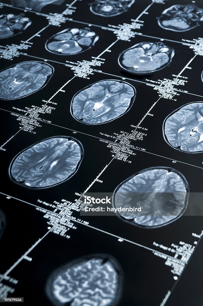 MRI 複数のイメージが表示される脳スキャンの頭とスカル - アルツハイマー病のロイヤリティフリーストックフォト
