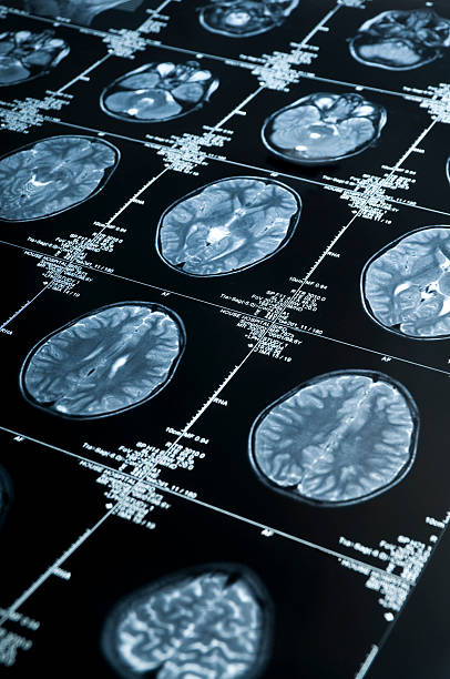 mri 複数のイメージが表示される脳スキャンの頭とスカル - brain mri scan alzheimers disease medical scan ストックフォトと画像