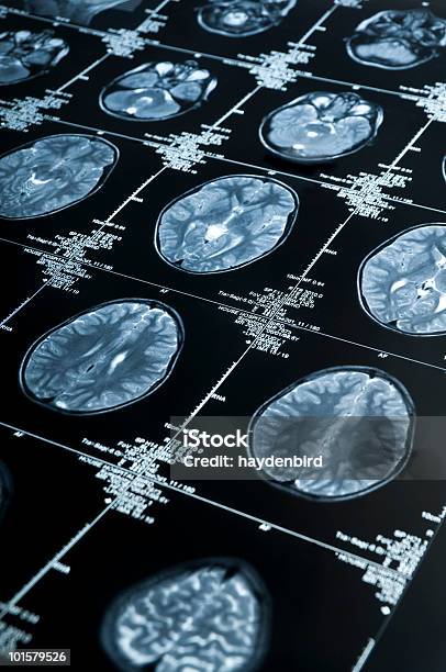 Mri 複数のイメージが表示される脳スキャンの頭とスカル - アルツハイマー病のストックフォトや画像を多数ご用意 - アルツハイマー病, MRI検査, テクノロジー