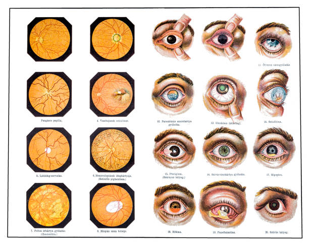 ilustrações, clipart, desenhos animados e ícones de problemas de olhos - choroid