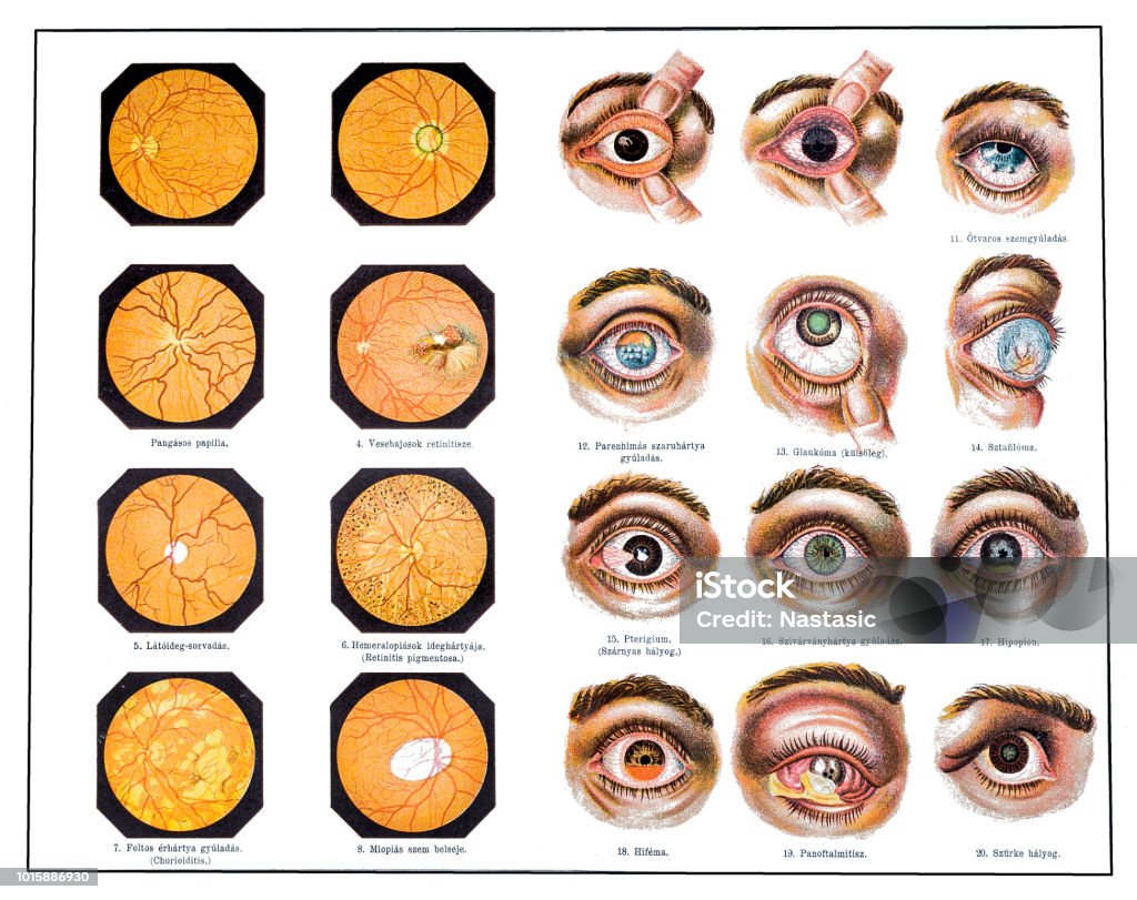 Inner Eye Problems Eye Problems Stock Illustration - Download Image Now - Anatomy ...