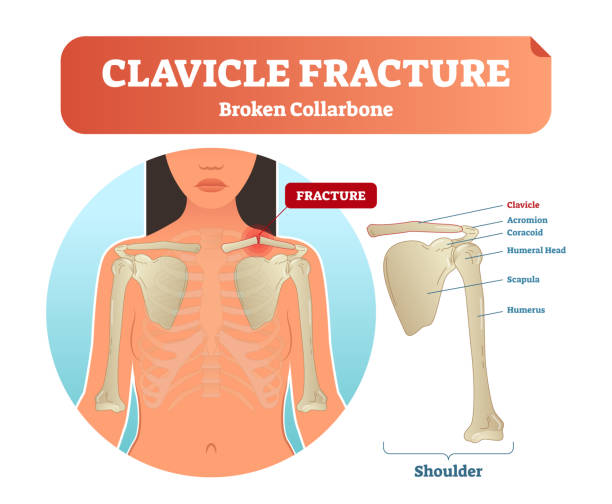 ilustrações de stock, clip art, desenhos animados e ícones de clavicle fracture with broken collarbone vector illustration. medical and anatomical labeled scheme with clavicle fracture, acromion, humeral head, scapula and humerus. - clavicle