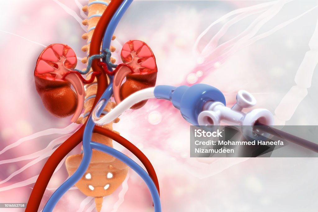Stent Angioplasty Peripheral Artery Disease Stock Photo - Download Image  Now - Dialysis, Artery, Catheter - iStock