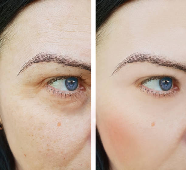 istock woman face wrinkles before and after pigmentation 1016555892